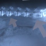 Goud acupunctuur bij spondylose